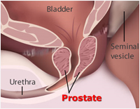 Holmium Laser Treatment for Prostate