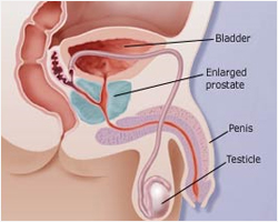 prostate disease