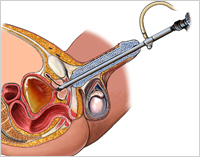 Prostate enlargement treatment in delhi