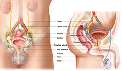 cancer prostate disease