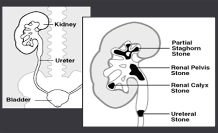 Kidney stone treatment in delhi