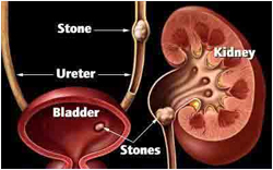 Kidney Stone Surgery