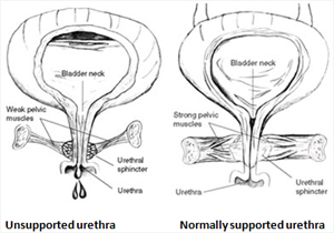 Urinary incontinence treatment