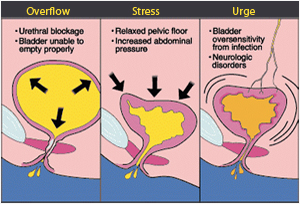 Urinary incontinence treatment in delhi